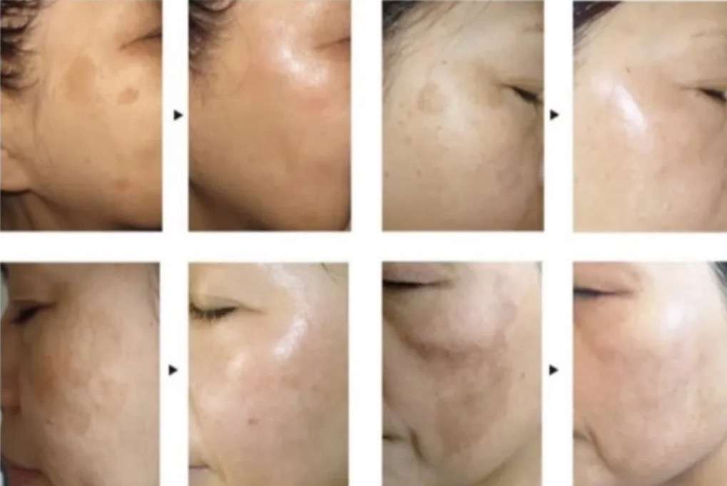 50代から急にシミが濃く見える理由